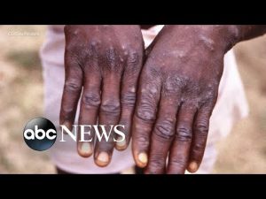 Read more about the article What to know about monkeypox