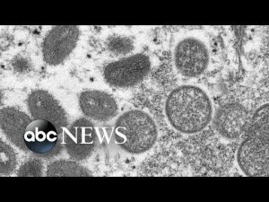 Read more about the article 7 people in the US confirmed or presumed to have monkeypox in 5 states l ABCNL