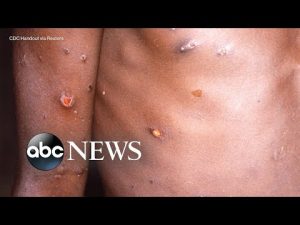 Read more about the article The symptoms, treatment for monkeypox