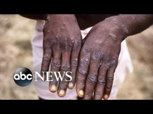 Read more about the article Monkeypox outbreak a global health emergency: WHO