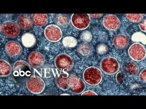 Read more about the article US leads world monkeypox cases l GMA