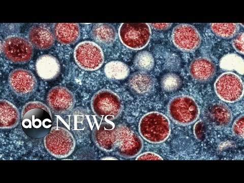 You are currently viewing US leads world monkeypox cases l GMA