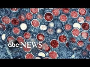 Read more about the article CDC issues new guidance as monkeypox cases reaches over 7,500 in US