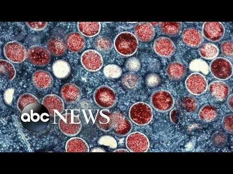 You are currently viewing CDC issues new guidance as monkeypox cases reaches over 7,500 in US