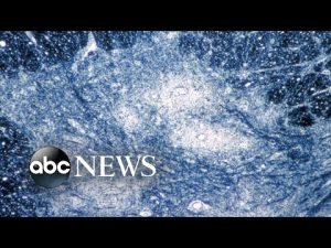 Read more about the article New York officials assessing potential spread after polio found in wastewater l ABCNL
