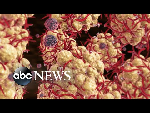 You are currently viewing White House monkeypox response team holds briefing | ABCNL