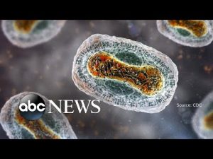 Read more about the article Texas reports 1st monkeypox death in US l WNT