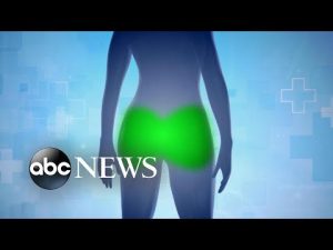 Read more about the article The dark side of illegal buttock injections | Nightline