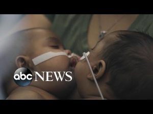 Read more about the article Historic surgery to separate twins