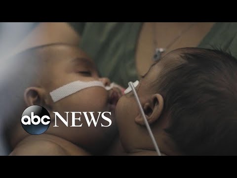 You are currently viewing Historic surgery to separate twins