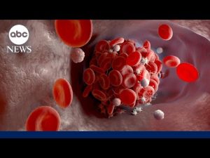 Read more about the article National Blood Clot Alliance: Someone dies of a blood clot in US every 6 minutes
