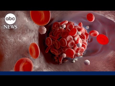You are currently viewing National Blood Clot Alliance: Someone dies of a blood clot in US every 6 minutes