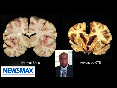 You are currently viewing The brain is resilient, gives up after a while: Dr. Ben Carson | The Record with Greta Van Susteren
