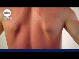 Read more about the article Men know they should wear sunscreen, so why aren’t they?