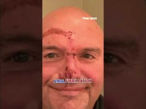 Read more about the article OUCH!: Fetterman reveals bloody face after fall sends him to hospital #shorts #usa #politics