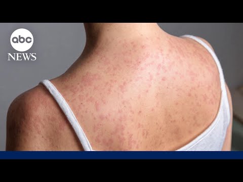 You are currently viewing Hundreds quarantined amid growing measles outbreak