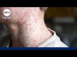 Read more about the article What to know about the measles outbreak in South Carolina