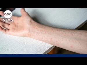 Read more about the article South Carolina measles outbreak doubles within a week