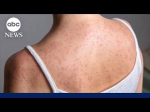 Read more about the article Measles cases surpass 900 in US with infections in 24 states: CDC