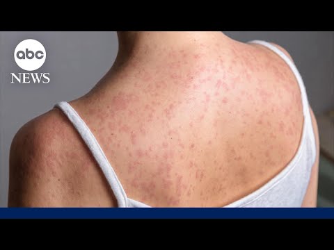 Read more about the article Measles cases surpass 900 in US with infections in 24 states: CDC