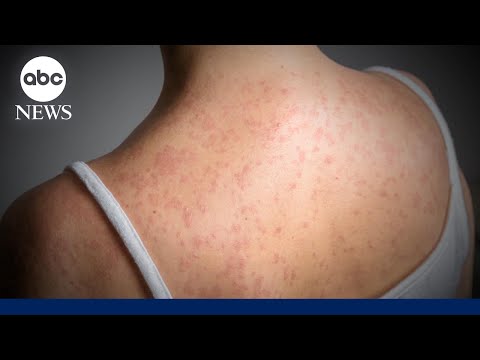 You are currently viewing Measles cases surpass 900 in US with infections in 24 states: CDC