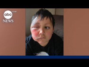 Read more about the article Mom shares warning after son is severely burned following social media trend