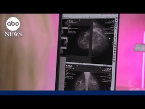 Read more about the article Mammogram screenings declining in key groups of younger women