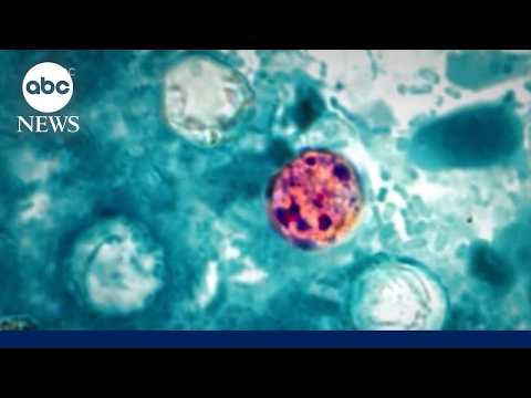 Read more about the article Cyclosporiasis cases surge after RFK Jr. said  outbreak was contained