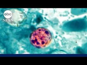 Read more about the article 2 dead from cyclosporiasis in Michigan
