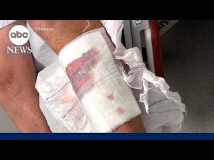 Read more about the article Connecticut man speaks out after shark attack in the Bahamas