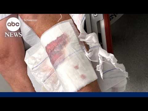 Read more about the article Connecticut man speaks out after shark attack in the Bahamas